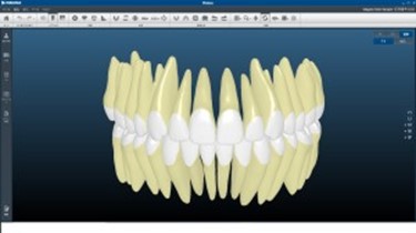 デジタル歯列矯正治療システム　INSIGNIA