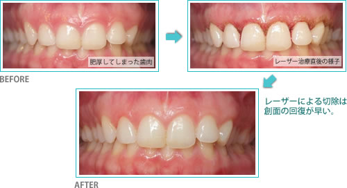 歯肉炎へのレーザー利用