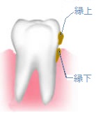 口内炎の消炎・除痛