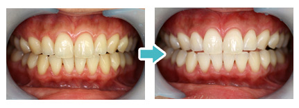 ホワイトニングの流れ